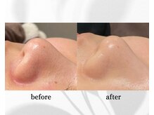 アン ビューティー(ann beauty)の雰囲気（【男女】毛穴ザラつき吸引除去♪《毛穴集中コース》初回→3回目）