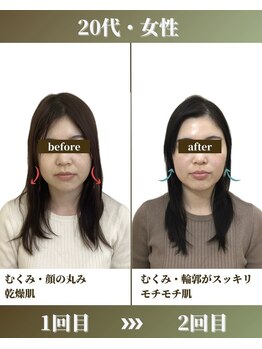 けいのき鍼灸整骨院/美容鍼2回の効果！美容鍼灸/小顔