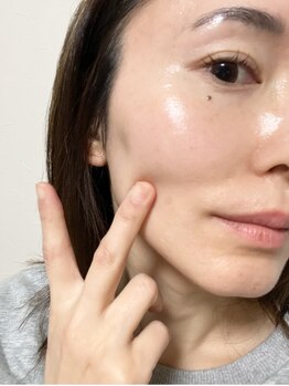 つばめの巣の写真/【韓国美肌★セルマン艶玉肌導入店】角質ケアで透明感あふれる肌へ！乾燥が気になる方にもオススメ＊