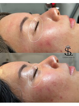 ルミナ シブヤ(LUMINA SHIBUYA)/【小ジワ】プラズマ1回目