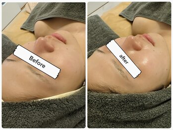 ルル リラクゼーション(RURU Relaxation)/REVIハーブピーリング1回