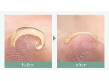 巻き爪ケアジェルもご用意してます♪