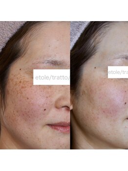 エトル(etole)/フォト美顔イオン導入＆トリプル