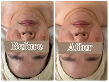 オン 絹(on silk)/小顔筋膜80分/1回施術