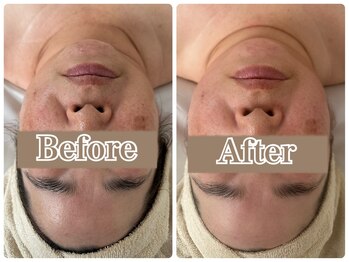 オン 絹(on silk)/小顔筋膜80分/1回施術