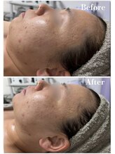 ルゼル(lezele)/小顔コルギ１回症例