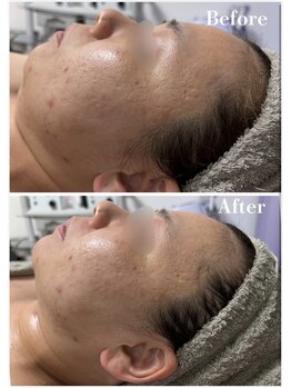 ルゼル(lezele)/小顔コルギ１回症例