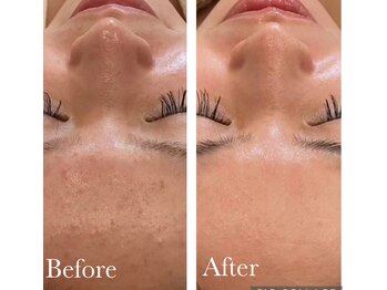 MMK/スムース肌☆凹凸レスの毛穴ケア