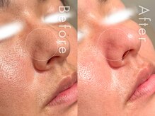 セルフミー 恵比寿(SELF Me...)/ハーブピーリング/毛穴改善