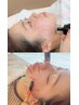 【小顔/トーンUP】美容鍼34本+パルス&高周波(RF)
