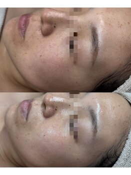 ココリール/くすみ・乾燥