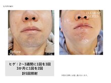 ロミオワックス ジュリエットワックス 新宿店(ROMEO Wax Juliet Wax)/髭脱毛/光脱毛ビフォーアフター