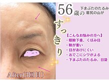 ケイ プレジール/瞼下垂・くぼみ目・重い瞼に♪