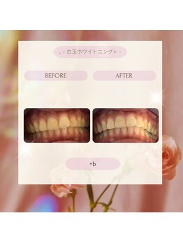 プラスビー 2号店(+b)/ホワイトニングビフォーアフター