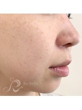 ベルメイク(BELLE MAKE)/リベル☆施術前（当日）