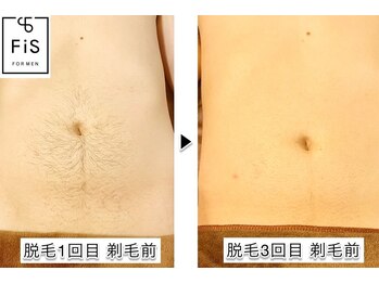 フィズ 経堂店(FIS)/☆施術写真☆［経堂/脱毛］
