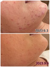 プルーム 久留米店(plume)/ハーブピーリング/ニキビケア