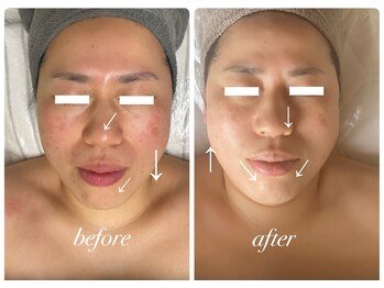 ディアンヌ(Diane)/フェイスライン/リフトアップ/顔