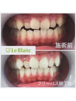 ルブラン 奈良店(Le Blanc)/歯を綺麗にしましょう♪