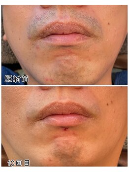 メンズサロン エイチ(H)/気になる青髭にも！！