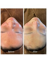 ビビ(VIVI)/ハーブピーリング症例（赤ら顔）