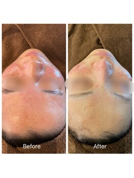 ビビ(VIVI)/ハーブピーリング症例（赤ら顔）