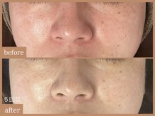 リムーン 岡崎(Re'moon)/REVI ハーブピーリング