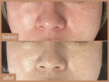 リムーン 岡崎(Re'moon)/REVI ハーブピーリング