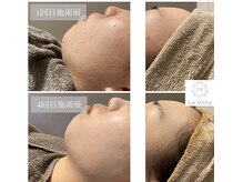 ラヴィオーラ 明石店(La Viora)/ダイヤモンドハーブピーリング