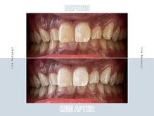 アイリー ホワイトニング 難波店/ビフォーアフター写真