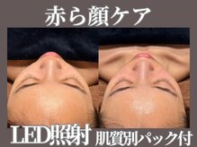 マヴィ 守口店(MavY.)/赤ら顔にはLED