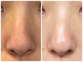 マクイエステティック 表参道店の写真/【毛穴レス肌へ。触って実感、鏡で感動】 ミネラル毛穴ケア!!開いた毛穴をキュッと引き締め・美肌診断付き