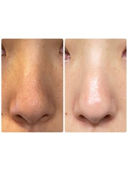 毛穴ケアをしたい