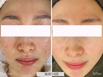 ニキビ研究所 千葉店/肌全体が変わり自信の持てる肌へ