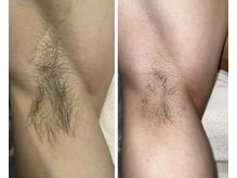 完全都度払い 明石メンズ脱毛/before/after 脇2回目