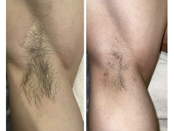 完全都度払い 明石メンズ脱毛/before/after 脇2回目