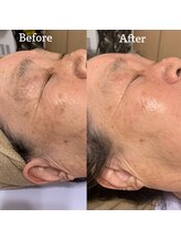 エレナ 伊勢崎(Ele'na)/ガリレオピーリングでシミケア