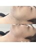 《ヒゲ初回》根こそぎ除去★メンズWAX脱毛+保湿鎮静パック付き¥8,800→¥6600