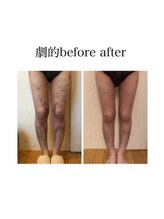 インディバケアプラチナム 横浜店/インディバ施術