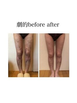 インディバケアプラチナム 横浜店/インディバ施術