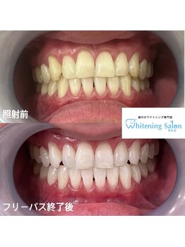 ホワイトニングサロン 熊本店/熊本でホワイトニング