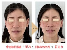 エソア(esoa)の雰囲気（面長短縮小顔矯正で別人級の輪郭へ♪歪み改善で若々しい印象に！）