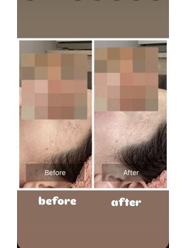 アンジュ(ANGE)/ガリレオピーリング症例凹凸肌