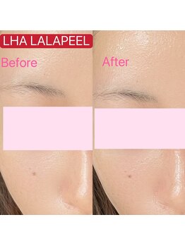 ドルチェナッツ ネオ 府内店(dolce nuts NEO)/ララピール＋新世代ヒーライト♪