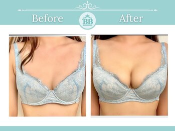 美人バスト 南森町店/バストアップ◇症例◇