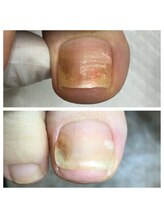 プラスキュア 用賀店(+CURE)/巻き爪矯正【1爪】＋爪切￥8800