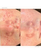 イチロクイチハチ(1618)/ホームケアとサロンケアでの変化