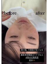 ノゾミジュク(希美熟 NOZOMIJUKU)/最新☆小顔美肌リフト