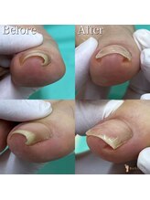 巻き爪補正店 越谷店/巻き爪補正