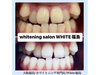 ホワイトニングサロン ホワイト(WHITE)/セルフホワイトニング/大阪/福島